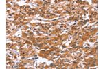 The image on the left is immunohistochemistry of paraffin-embedded Human thyroid cancer tissue using CSB-PA170354(GLMN Antibody) at dilution 1/30, on the right is treated with synthetic peptide. (Original magnification: 
