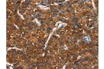 The image on the left is immunohistochemistry of paraffin-embedded Human liver cancer tissue using CSB-PA170398(CTBP1 Antibody) at dilution 1/40, on the right is treated with synthetic peptide. (Original magnification: 