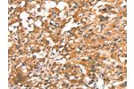 The image on the left is immunohistochemistry of paraffin-embedded Human thyroid cancer tissue using CSB-PA170450(DAP Antibody) at dilution 1/15, on the right is treated with synthetic peptide. (Original magnification: 