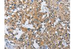 The image on the left is immunohistochemistry of paraffin-embedded Human thyroid cancer tissue using CSB-PA171435(FGF9 Antibody) at dilution 1/40, on the right is treated with fusion protein. (Original magnification: 