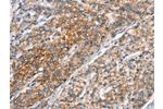 The image on the left is immunohistochemistry of paraffin-embedded Human prostate cancer tissue using CSB-PA171908(ALCAM Antibody) at dilution 1/25, on the right is treated with synthetic peptide. (Original magnification: 