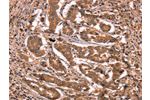 The image on the left is immunohistochemistry of paraffin-embedded Human breast cancer tissue using CSB-PA171912(BCL6 Antibody) at dilution 1/15, on the right is treated with synthetic peptide. (Original magnification: 