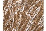 The image on the left is immunohistochemistry of paraffin-embedded Human gastic cancer tissue using CSB-PA172172(BAI1 Antibody) at dilution 1/40, on the right is treated with synthetic peptide. (Original magnification: 
