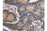 The image is immunohistochemistry of paraffin-embedded Human colon cancer tissue using CSB-PA172178(FSTL1 Antibody) at dilution 1/40. (Original magnification: 