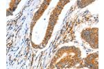 The image on the left is immunohistochemistry of paraffin-embedded Human colon cancer tissue using CSB-PA172235(CCNF Antibody) at dilution 1/30, on the right is treated with fusion protein. (Original magnification: 