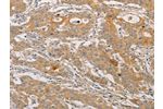 The image on the left is immunohistochemistry of paraffin-embedded Human gastic cancer tissue using CSB-PA172514(ARSK Antibody) at dilution 1/30, on the right is treated with fusion protein. (Original magnification: 