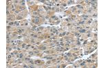 The image on the left is immunohistochemistry of paraffin-embedded Human liver cancer tissue using CSB-PA172691(CFAP45 Antibody) at dilution 1/25, on the right is treated with synthetic peptide. (Original magnification: 