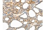 The image on the left is immunohistochemistry of paraffin-embedded Human thyroid cancer tissue using CSB-PA172806(CCR8 Antibody) at dilution 1/40, on the right is treated with synthetic peptide. (Original magnification: 