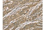 The image on the left is immunohistochemistry of paraffin-embedded Human gastic cancer tissue using CSB-PA173108(EIF3F Antibody) at dilution 1/25, on the right is treated with fusion protein. (Original magnification: 