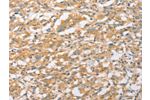 The image on the left is immunohistochemistry of paraffin-embedded Human thyroid cancer tissue using CSB-PA173231(EPS15L1 Antibody) at dilution 1/20, on the right is treated with fusion protein. (Original magnification: 