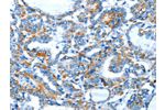 The image on the left is immunohistochemistry of paraffin-embedded Human thyroid cancer tissue using CSB-PA173556(BACE1 Antibody) at dilution 1/15, on the right is treated with fusion protein. (Original magnification: 