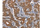 The image on the left is immunohistochemistry of paraffin-embedded Human gastic cancer tissue using CSB-PA174401(CDC23 Antibody) at dilution 1/50, on the right is treated with synthetic peptide. (Original magnification: 