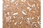 The image on the left is immunohistochemistry of paraffin-embedded Human ovarian cancer tissue using CSB-PA174494(CCL17 Antibody) at dilution 1/60, on the right is treated with synthetic peptide. (Original magnification: 