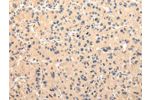 The image on the left is immunohistochemistry of paraffin-embedded Human liver cancer tissue using CSB-PA174496(CMKLR1 Antibody) at dilution 1/30, on the right is treated with synthetic peptide. (Original magnification: 