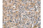 The image on the left is immunohistochemistry of paraffin-embedded Human liver cancer tissue using CSB-PA174578(CHMP4B Antibody) at dilution 1/40, on the right is treated with fusion protein. (Original magnification: 