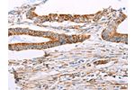 The image on the left is immunohistochemistry of paraffin-embedded Human colon cancer tissue using CSB-PA174758(ATP5J Antibody) at dilution 1/15, on the right is treated with fusion protein. (Original magnification: 
