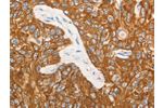 The image on the left is immunohistochemistry of paraffin-embedded Human esophagus cancer tissue using CSB-PA174940(CSF3 Antibody) at dilution 1/15, on the right is treated with synthetic peptide. (Original magnification: 
