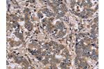 The image on the left is immunohistochemistry of paraffin-embedded Human liver cancer tissue using CSB-PA175167(FGL2 Antibody) at dilution 1/20, on the right is treated with fusion protein. (Original magnification: 
