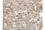 The image on the left is immunohistochemistry of paraffin-embedded Human liver cancer tissue using CSB-PA175261(BRWD1 Antibody) at dilution 1/25, on the right is treated with synthetic peptide. (Original magnification: 