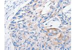 The image on the left is immunohistochemistry of paraffin-embedded Human esophagus cancer tissue using CSB-PA176239(FANCF Antibody) at dilution 1/100, on the right is treated with fusion protein. (Original magnification: 