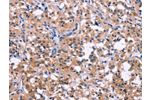 The image on the left is immunohistochemistry of paraffin-embedded Human thyroid cancer tissue using CSB-PA176280(DUSP13 Antibody) at dilution 1/50, on the right is treated with fusion protein. (Original magnification: 
