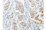 The image on the left is immunohistochemistry of paraffin-embedded Human breast cancer tissue using CSB-PA176345(ARHGEF10 Antibody) at dilution 1/45, on the right is treated with fusion protein. (Original magnification: 