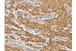 The image on the left is immunohistochemistry of paraffin-embedded Human gastic cancer tissue using CSB-PA176612(ARHGAP25 Antibody) at dilution 1/40, on the right is treated with fusion protein. (Original magnification: 
