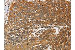 The image on the left is immunohistochemistry of paraffin-embedded Human cervical cancer tissue using CSB-PA176976(DCTN2 Antibody) at dilution 1/25, on the right is treated with fusion protein. (Original magnification: 