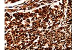 The image is immunohistochemistry of paraffin-embedded Human lung cancer tissue using CSB-PA177370(BOLL Antibody) at dilution 1/10. (Original magnification: 