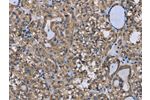 The image on the left is immunohistochemistry of paraffin-embedded Human thyroid cancer tissue using CSB-PA177666(FOXO1  Antibody) at dilution 1/20, on the right is treated with synthetic peptide. (Original magnification: 