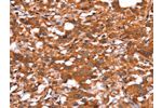 The image on the left is immunohistochemistry of paraffin-embedded Human thyroid cancer tissue using CSB-PA177709(GLS Antibody) at dilution 1/15, on the right is treated with synthetic peptide. (Original magnification: 