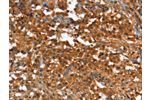 The image on the left is immunohistochemistry of paraffin-embedded Human thyroid cancer tissue using CSB-PA177791(CR1 Antibody) at dilution 1/25, on the right is treated with synthetic peptide. (Original magnification: 