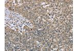 The image on the left is immunohistochemistry of paraffin-embedded Human cervical cancer tissue using CSB-PA177824(DACH2 Antibody) at dilution 1/40, on the right is treated with fusion protein. (Original magnification: 