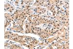 The image on the left is immunohistochemistry of paraffin-embedded Human liver cancer tissue using CSB-PA178606(DDX4 Antibody) at dilution 1/20, on the right is treated with fusion protein. (Original magnification: 