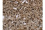 The image on the left is immunohistochemistry of paraffin-embedded Human esophagus cancer tissue using CSB-PA178639(ANP32E Antibody) at dilution 1/20, on the right is treated with synthetic peptide. (Original magnification: 