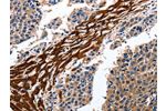 The image on the left is immunohistochemistry of paraffin-embedded Human liver cancer tissue using CSB-PA178836(CYP3A4 Antibody) at dilution 1/15, on the right is treated with fusion protein. (Original magnification: 