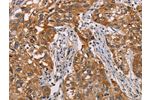 The image on the left is immunohistochemistry of paraffin-embedded Human esophagus cancer tissue using CSB-PA178887(CRYAB Antibody) at dilution 1/25, on the right is treated with fusion protein. (Original magnification: 