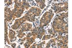 The image on the left is immunohistochemistry of paraffin-embedded Human breast cancer tissue using CSB-PA178890(ARL6IP1 Antibody) at dilution 1/30, on the right is treated with fusion protein. (Original magnification: 