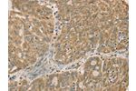 The image on the left is immunohistochemistry of paraffin-embedded Human ovarian cancer tissue using CSB-PA178912(DMRT3 Antibody) at dilution 1/50, on the right is treated with fusion protein. (Original magnification: 