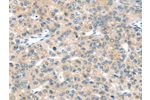 The image on the left is immunohistochemistry of paraffin-embedded Human liver cancer tissue using CSB-PA179150(EPHA2 Antibody) at dilution 1/20, on the right is treated with synthetic peptide. (Original magnification: 