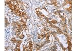 The image on the left is immunohistochemistry of paraffin-embedded Human colon cancer tissue using CSB-PA179189(CA9 Antibody) at dilution 1/50, on the right is treated with fusion protein. (Original magnification: 