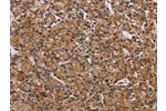 The image on the left is immunohistochemistry of paraffin-embedded Human prostate cancer tissue using CSB-PA179611(AATK Antibody) at dilution 1/45, on the right is treated with synthetic peptide. (Original magnification: 