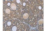 The image on the left is immunohistochemistry of paraffin-embedded Human thyroid cancer tissue using CSB-PA179620(BRAF Antibody) at dilution 1/60, on the right is treated with synthetic peptide. (Original magnification: 