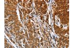 The image on the left is immunohistochemistry of paraffin-embedded Human gastic cancer tissue using CSB-PA179766(BCAP31 Antibody) at dilution 1/30, on the right is treated with fusion protein. (Original magnification: 