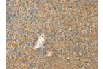 The image on the left is immunohistochemistry of paraffin-embedded Human liver cancer tissue using CSB-PA179815(AANAT Antibody) at dilution 1/40, on the right is treated with fusion protein. (Original magnification: 