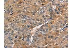 The image on the left is immunohistochemistry of paraffin-embedded Human liver cancer tissue using CSB-PA180634(APOC4 Antibody) at dilution 1/15, on the right is treated with synthetic peptide. (Original magnification: 