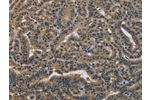 The image on the left is immunohistochemistry of paraffin-embedded Human thyroid cancer tissue using CSB-PA180704(DNAJA1 Antibody) at dilution 1/30, on the right is treated with fusion protein. (Original magnification: 