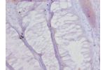 Immunohistochemistry of paraffin-embedded human colon cancer gland using CSB-PA18099A0Rb at dilution 1:20