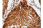 The image is immunohistochemistry of paraffin-embedded Human cervical cancer tissue using CSB-PA181054(ABCB5 Antibody) at dilution 1/10. (Original magnification: 