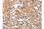 The image on the left is immunohistochemistry of paraffin-embedded Human thyroid cancer tissue using CSB-PA181130(AIMP1 Antibody) at dilution 1/40, on the right is treated with synthetic peptide. (Original magnification: 